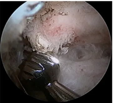 Fig. 6. Arthroscopic views during rectus femoris ossiﬁcation removal.