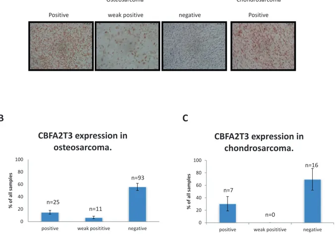 Figure 6: Immunohistochemical assessment of CBFA2T3 expression in OS and chondrosarcomas