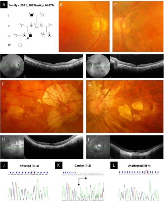 Figure 1.  Pedigree of a non-consanguineous family with X-linked retinitis pigmentosa (RP) and  pathologic myopia (PM), retinal imaging, and novel frame-shift mutation identified in exon ORF15 of  RPGR gene