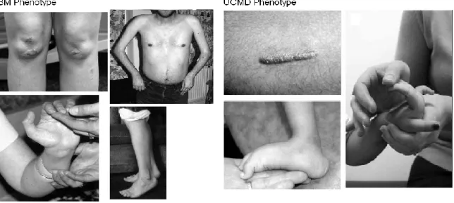 Figure 2 (Lampe AK &amp; Bushby KM. 2005). Pictures from clinical patients with Bethlem Myopathy (BM) phenotype  from  left  to  right;  Skin  follicular  hyperkeratosis  and  distal  contractures  in  elbows,  fingers  and  ankle