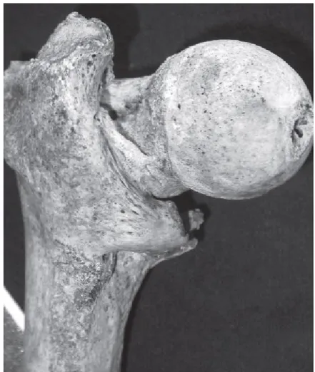 Figura 1. Frattura del collo del femore di una donna di 80 anni (Curate et al., 2009) 