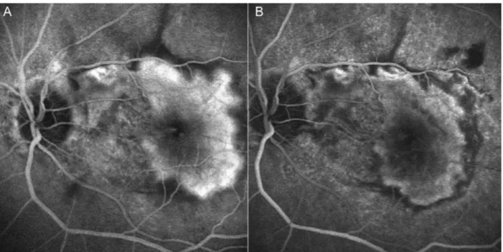 Figure 1. Two cases of classic choroidal neovascularization (CNV)  lesion treated with PDT-V