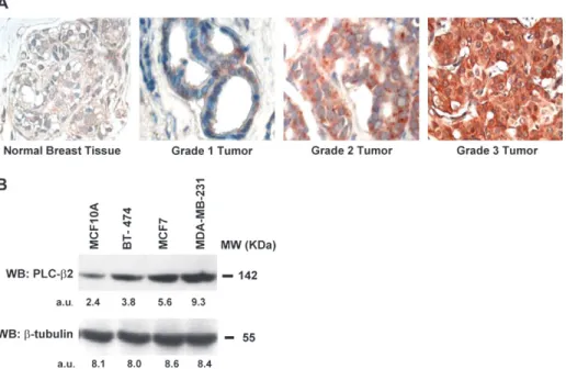Fig. 1. PLC-b2 expression correlates with malignancy of breast cancer cells. (A) Immunohistochemical analysis performed with an anti-PLC-b2 antibody on deparaffinized tissue sections of human healthy and tumoral breast tissues with different histopatologic