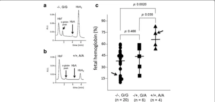 Fig. 4 Relationship between the −158 XmnI Gγ-globin and +25 Aγ-globin gene polymorphisms and the level of fetal hemoglobin (HbF) in erythroid precursor cells from β 0 39/ β 0 39 thalassemia patients