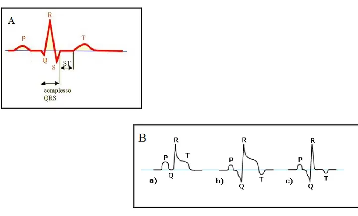 Figura  5.  A)  Rappresentazione  schematica  di  un  tracciato  ECG  normale.  B)  Schema  di  ECG  dopo  IMA:  a)  prime  quattro  ore:  elevazione  del  segmento  ST;  b)  a  quattro  giorni:  comparsa  delle  onde  Q  e  T  negative;  c)  a  quattro  s