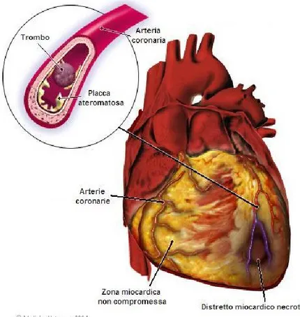 Figura  1  Infarto  miocardico  acuto  con  conseguente  necrosi  di  un  distretto  cardiaco  dovuta  all’occlusione  dell’arteria coronaria sinistra da parte di un trombo in prossimità di una placca ateromatosa