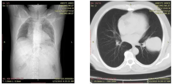 Figure  1  (left):  X-ray  showing  a  central  shadow  in  the  left  lung  with  elevated  diaphragm