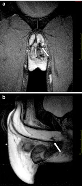 Fig. 2 a-b Intrascrotal rupture of the corpus cavernosum (arrow). a T2- T2-weighted FFE sequence, coronal view; b T2-T2-weighted SPIR TSE sequence, sagittal view