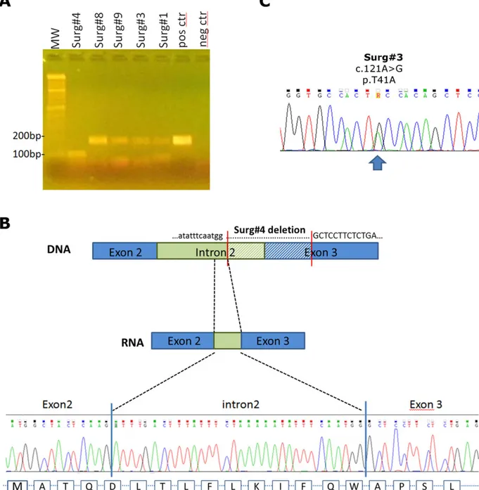 FIGURE 3 mRNA expression of CTNNB1 mutations. (A) RT-PCR of RNA extracted from 5 surgically treated DT