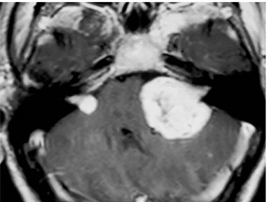 Figura 1: RMI con m.d.c. dell’encefalo, in proiezione assiale, che mostra la presenza di schwannomi  vestibolari bilaterali, segno patognomonico di NF2 