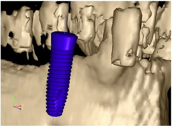 Fig. 2.9. A 3D view rendering of an implant CAD model loaded from file  