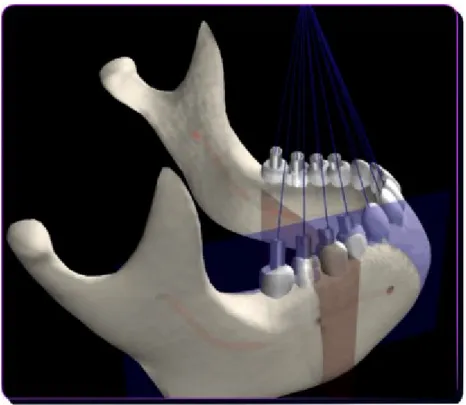 Fig. 4.5.  Teeth axes convergence towards a specific point 