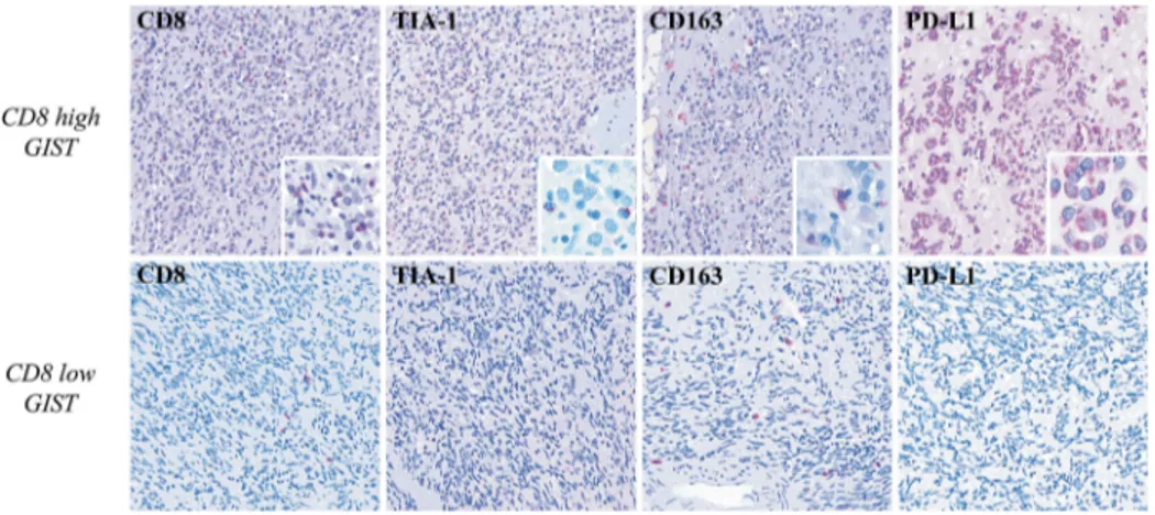 Figure 3. Immunohistochemical characterization of GIST samples. In the upper row, one high-CD8 + GIST shows high number of Tia-1 + (x100) (inset: x400) cell of microenvironment, presence of M2 CD163 + macrophages (x100) (inset: x400), and PD-L1 positivity 