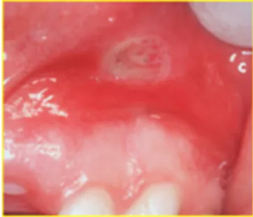 Figure 3. Oral manifestations of IBD: apthous stomatis in the vestibular sulci. 