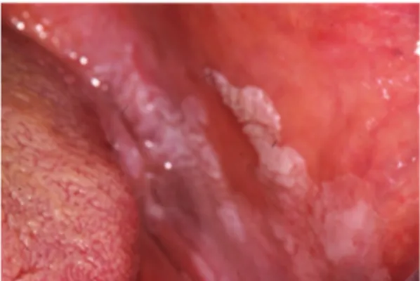 Figure 4. Oral manifestation of IBD: lichen planus in the left buccal mucosa. 