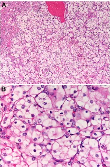 Figure 5: Malignant tumors. “Conventional” clear cell renal carcinoma, 100X(A) and 400X(B), hematoxylin and eosin