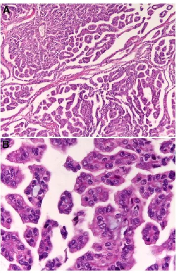 Figure 6: Malignant tumors. Papillary renal cell renal carcinoma type 1, 100X(A) and 400X(B), hematoxylin and eosin