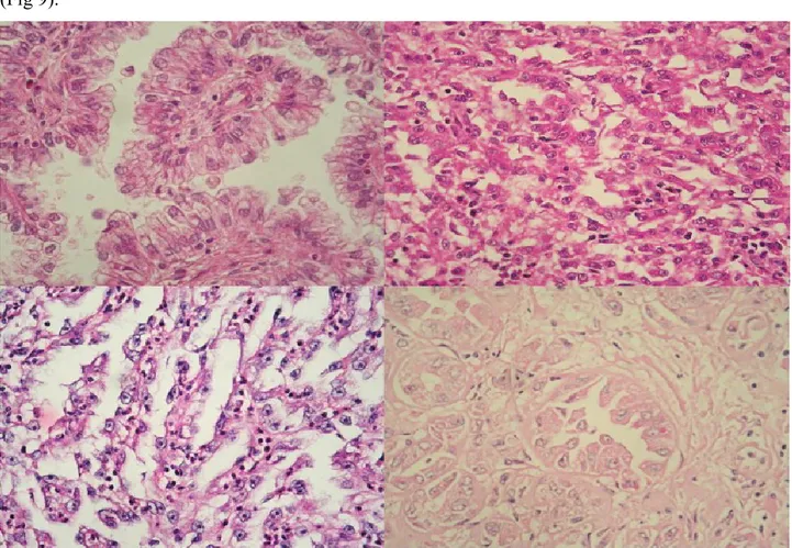 Figura  9:  Malignant  tumors.  Collecting  duct  carcinoma:  representative  examples  of  4  different  cases  of  Bellini’s 