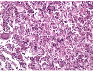 Figura 10: Epithelioid and giant cells showing no definite pattern of growth in an epithelioid angiomyolipoma