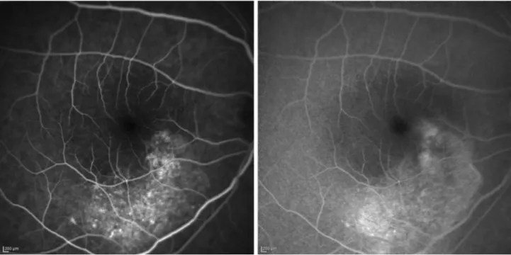 Figure 3 Early and late ﬂuorescein angiograms of a 29-year-old patient affected by chronic central serous chorio-retinopathy revealing an irregularity of the retinal pigment epithelium, resembling a “honeycomb” pattern, near the point of ﬂuorescein leakage