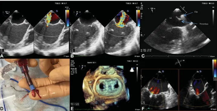 Fig. 1 Intraprocedural echocardiography and clip thrombosis. (A) Intraprocedural transesophageal echocardiography (TEE) color Doppler at the left ventricular outﬂow tract view showing severe mitral regurgitation (MR)
