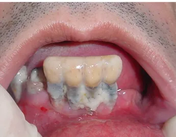 Figure 2. Severe periodontal disease and partial edentulism in subjects suffering from dementia