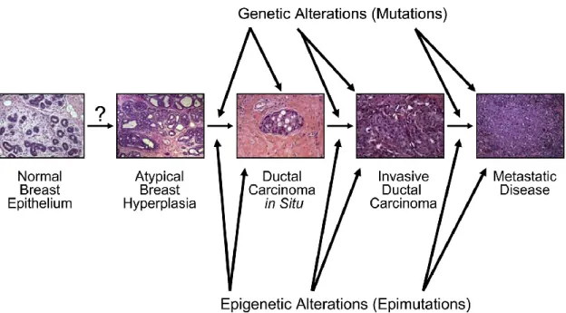 Figure  2.  Natural  history  of  breast  cancer  development.  Breast  cancer  develops  from  normal  breast  epithelial  cells  that  evolve  through  atypical  hyperplasia  (and  eventually  dysplasia),  DCIS,  and  invasive  breast  cancer