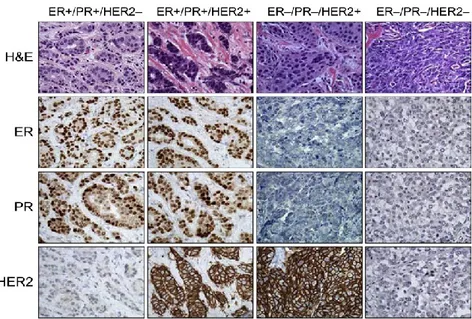 Figure  3. Clinical  classification  of  invasive  breast  cancer  based  on  expression  of  ER,  PR,  and  HER2