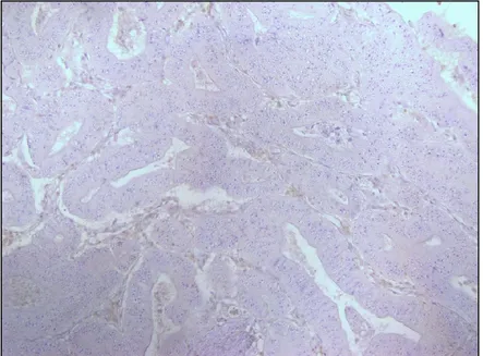 Figure  1:  Immunohistochemical  staining  results  of  PMS2.  (a)  PMS2  negative  by 