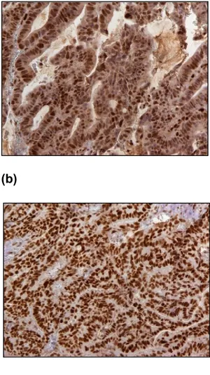 Figure  2:  Immunohistochemical  staining  results  of  MSH2,  MSH6,  MLH1  and 