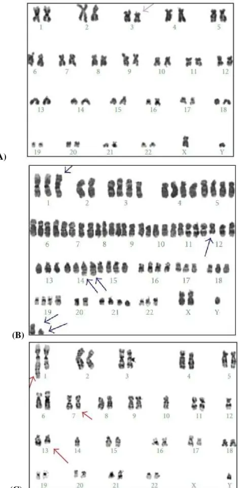 Figure 3: G-banding karyotypes showing some examples of poor quality (score2—(a), patient  14), sufficient quality (score3—(b), patient 4), and good quality (score4—(c), patient 16)