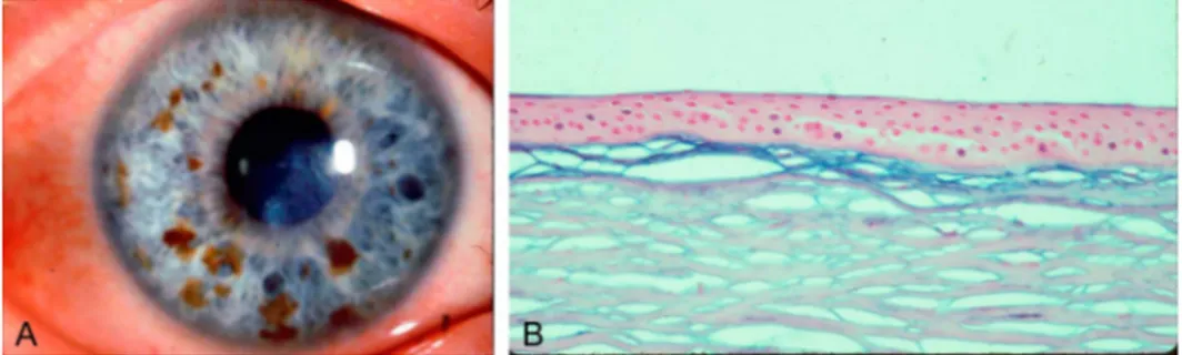 FIGURE 3. Subepithelial mucinous corneal dystrophy. A, Slit-lamp  bio-microscopy reveals that diffuse  sub-epithelial opacities and haze are densest centrally