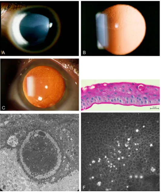 FIGURE 4. Meesmann corneal dys- dys-trophy. A, In direct illumination, diffuse gray, superior opacity with a distinct border is apparent