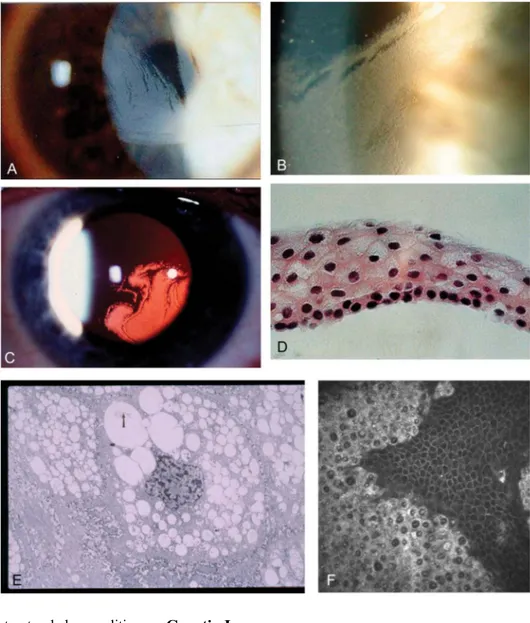 FIGURE 5. Lisch epithelial corneal dystrophy. A and B, Diffuse grayish epithelial opacities form radial, feathery or club-shaped patterns