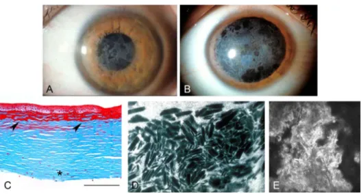 FIGURE 7. Reis–Bu ¨cklers corneal dystrophy. A, Confluent irregular, geographic-like opacities