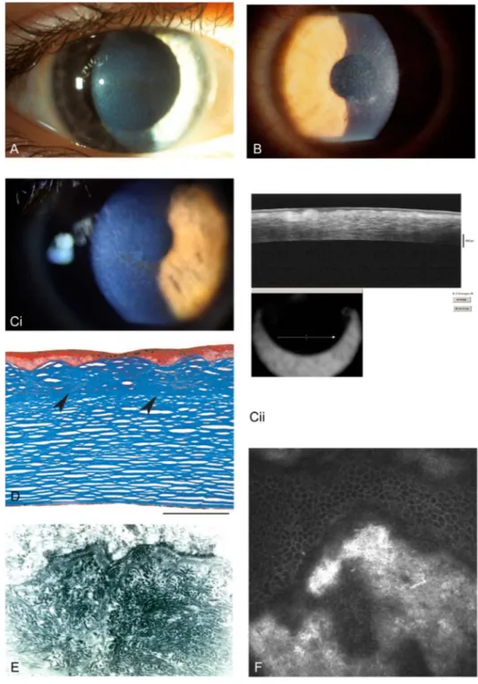FIGURE 8. Lattice Corneal Dystro- Dystro-phy, type 1 (LCD). A, Initial signs of mild honeycomb appearance
