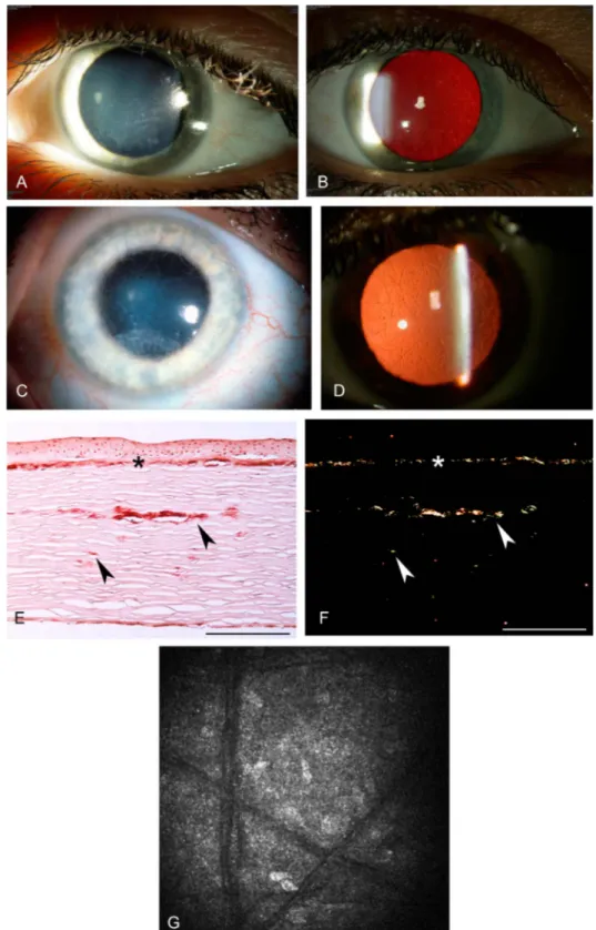 FIGURE 9. Lattice corneal dystro- dystro-phy, type 1 (classic lattice). Direct (A) and retroillumination (B) of early lattice corneal dystrophy (LCD) with dots and fine lattice lines with genetic confirmation of Arg124Cys in TGFBI