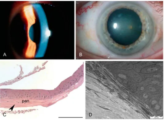 FIGURE 2. Franceschetti corneal dystrophy. A, In first decades of life, the cornea appears normal without any dystrophy-specific signs after recurrent epithelial erosion