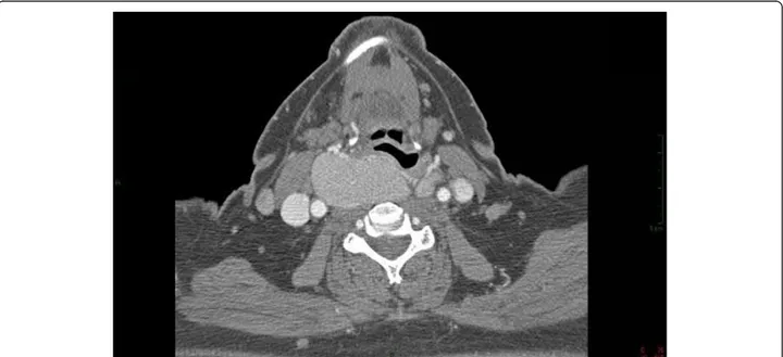 Figure 1 Preoperative computed tomography scan shows the goiter compressing trachea and esophagus.
