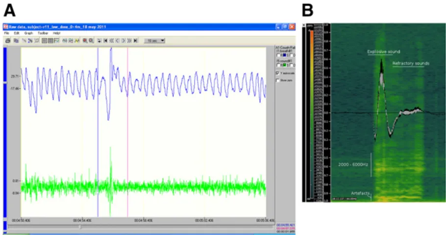 Fig. 1. (A) Screenshot of the simultaneous change in pressure and sound that EMKA uses to classify a cough event