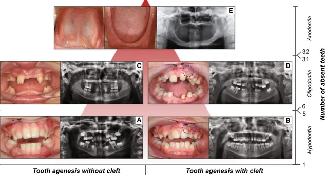 Fig. 1   Forms of tooth agenesis. Panel of tooth agenesis (TA) forms  in the permanent dentition, listed according to the number of absent  teeth