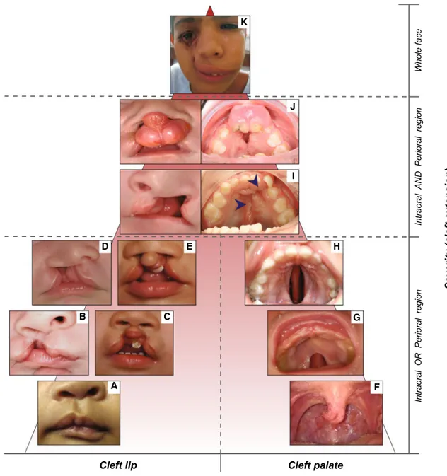 Fig. 2   Forms of orofacial clefts. Panel of orofacial cleft forms, listed  according to the severity based on the cleft extension and orofacial  regions affected