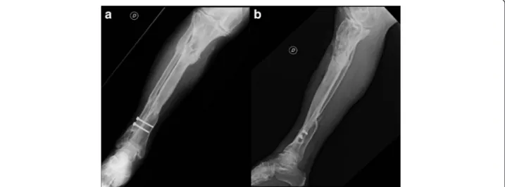 Fig. 1 Anteroposterior (a) and lateral (b) x-rays of the tibia showing an area of inhomogeneous osteostructural depletion at the proximal third of the tibia