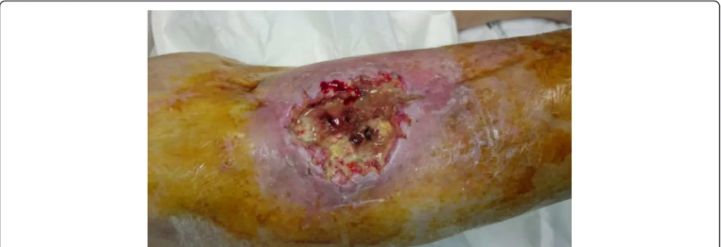 Fig. 5 Clinical photography of the wound after wide-margin surgical debridement and bioglass removal