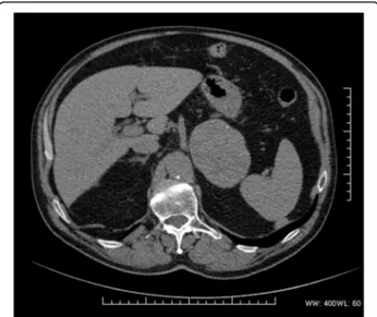 Fig. 1 CT scan showing a large homogeneous lesion with rare peripheral calcifications