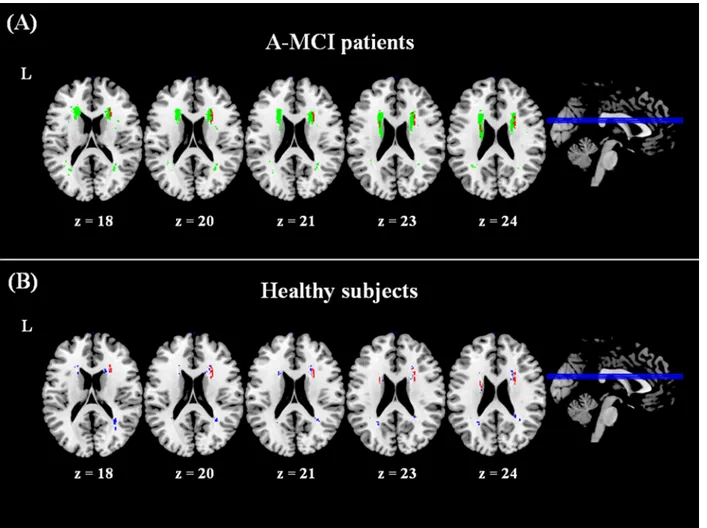 Fig 3. Results of voxel lesion-symptom mapping analyses. A significant association was found between the anatomical localization of white matter lesion in the anterior thalamic radiation (areas in red) and the presence/severity of apathy in between amnesti