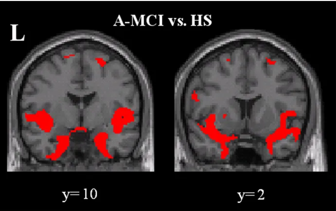 Fig 4. Pattern of regional grey matter atrophy in all a-MCI patients compared to controls