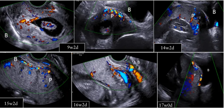Figure 4 Development of abnormally invasive placenta from Cesarean scar pregnancy. B, bladder; P, placenta