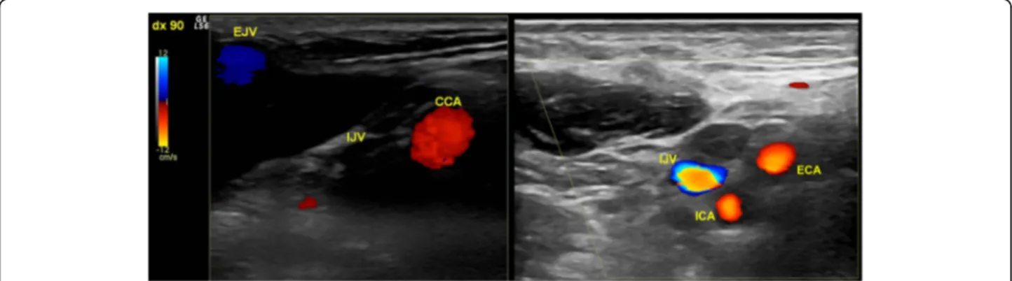 Fig. 2 Transverse access CDU of the upper neck of the illustrative case. It is well apparent on the left a collapsed empty internal jugular vein (IJV) without any Doppler flow signal and an enlarged external jugular vein (EJV)