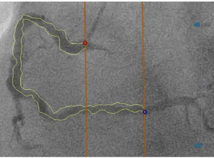 Figure 1 Low angiographic quality. The QFR application has difficulties finding the vessel lumen 